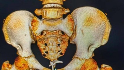 12岁男孩下体插着电线就诊！医生：这些尿道异物要注意