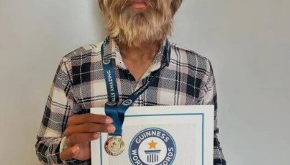印度少年面部95%被毛发覆盖 打破吉尼斯世界纪录